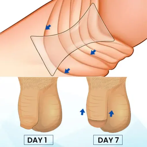 AEXZR™ Prepuce Correction Patch