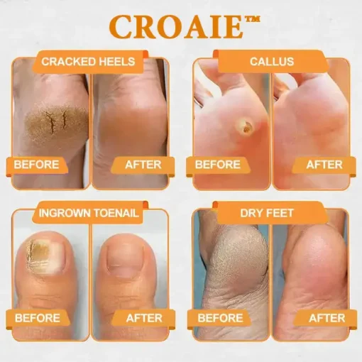 CROAIE™ Bee Venom & Herbal Slimming Foot Patches for Lymphatic Support and Blood Sugar Balance