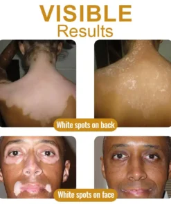 Dobshow™ BeeVenom Vitiligo Treatment Cream