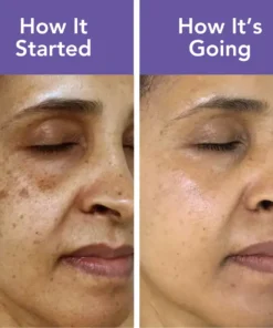 Fivfivgo™ Age Spots Removal Patches