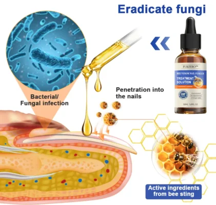 Furzero™ Bee Venom Nail Folliculitis Treatment