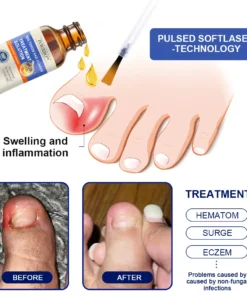 Furzero™ Bee Venom Nail Fungus Treatment Solution