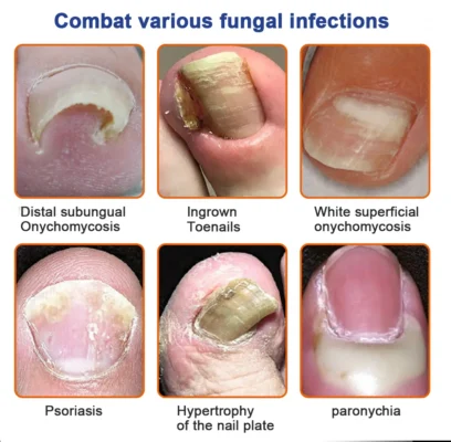 Furzero™ Bee Venom Nail Fungus Treatment Solution