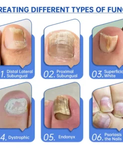 Hermsa™ PureNail Fungus Laser Device