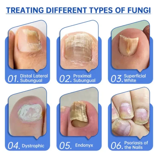 Hermsa™ PureNail Fungus Laser Device