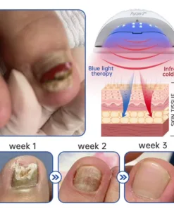 Hermsa™ PureNail Fungus Laser Device