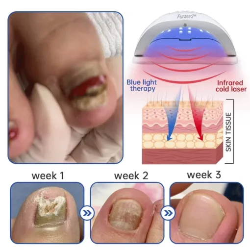 Hermsa™ PureNail Fungus Laser Device