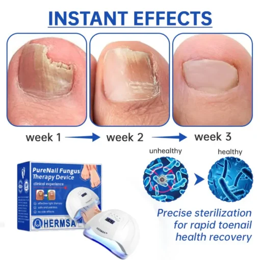 Hermsa™ PureNail Fungus Laser Device