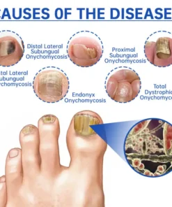 Hermsa™ PureNail Fungus Laser Device