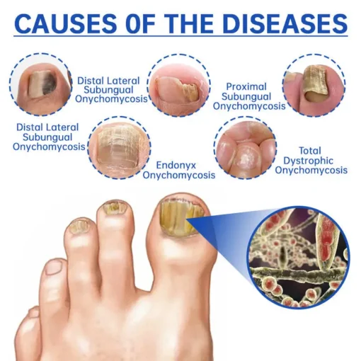 Hermsa™ PureNail Fungus Laser Device