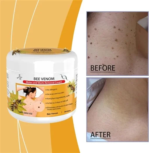 LOVILDS™Bee Venom Mole and Wart Treatment Cream