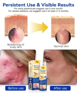 Ourlyard™ Bee Venom Advanced Psoriasis Treatment Cream