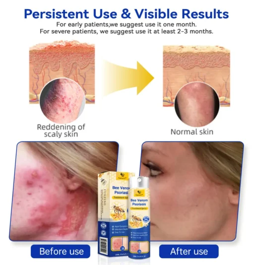 Ourlyard™ Bee Venom Advanced Psoriasis Treatment Cream