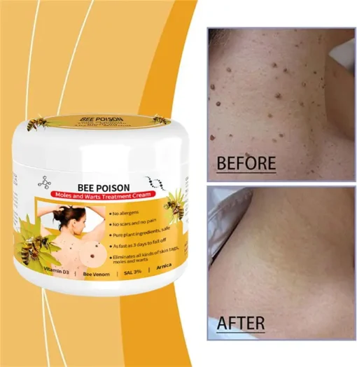 QIAWI™ BEE POSON MOLE AND WART TREATMENT CREAM