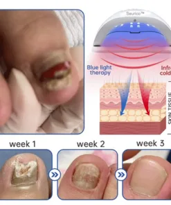 Seurico™ PureNail Fungus Laser Device